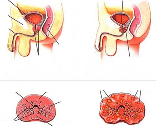 próstata normal e prostatite crônica
