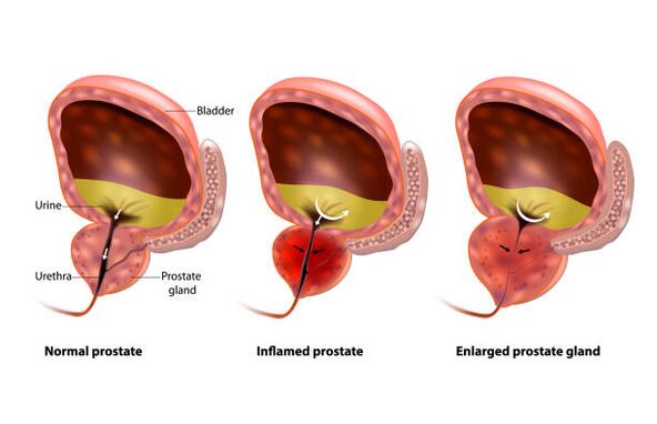 prostatite é uma inflamação da próstata